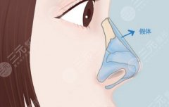 上海国际医学中心隆鼻价格，有人花几万有人十几万？价格差异全拆解