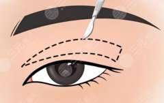 成都眼修复医生排名，从案例难度、审美风格到患者反馈全面对比