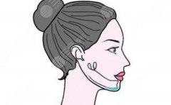 颏成型和假体隆下巴哪种好？从脸型基础、效果持久性到维护难度全面对比