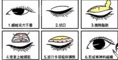郭庆医生怎么样-双眼皮-眼整形-海口鹏爱医疗美容医院
