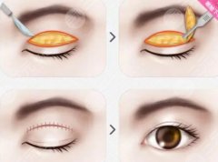 何静医生怎么样-双眼皮-眼整形-雅芳亚医疗美容医院