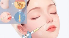 邝石峰医生脂肪填充案例