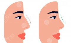 上海做鼻子的价格是多少？材料、医生、医院等级对费用的影响逐项拆分