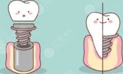 国内种植牙医院排名，国内口碑较好的种植牙医院排名＋就诊建议