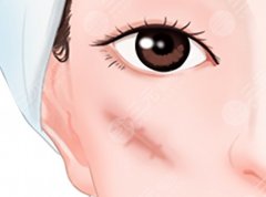 喜雯婧做的疤痕手术效果不大怎么办？如何与医生沟通、调整预期并选择合适修复方案