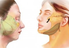 重庆哪家做拉皮的医院好？面部提升实力机构和常见手术方式全盘点