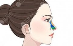 做硅胶隆鼻大概多少钱?影响价格的关键因素和省钱小技巧