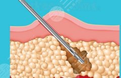 任学会吸脂怎么样？术后满意度、风险点和适合人群客观整理