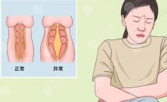 做腹直肌修复多少钱?手术价格构成、影响费用的因素和医保可能性说明