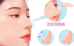 半肋骨鼻和全肋骨鼻哪个更好？从支撑力、塑形空间到疤痕位置一文讲透