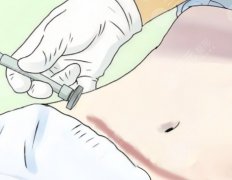腹壁皮肤脂肪切除术，疤痕位置、风险点和术后护理要点全解析