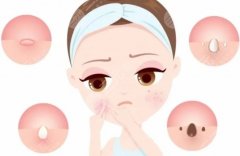 去痘印痘坑做什么医美？常见医美项目组合方案和大致价格区间整理