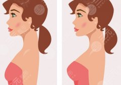 北京协和医院丰胸价格，术前检查到术后复查的整体预算一文算清