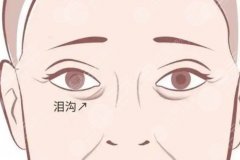 北京玻尿酸填充泪沟最佳年龄，从皮肤状态、凹陷程度分析适合介入的时间点