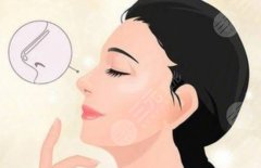 膨体隆鼻几天才消肿？正常消肿时间和异常情况判断指南