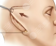 中下面部拉皮和双眼皮哪个痛？看看谁才是医美界的“疼痛刺客”