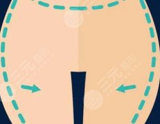 妈妈臀吸脂需要多少钱？价格大揭秘，这些坑别踩