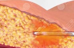 胳膊吸脂和腰腹吸脂哪个疼？疼痛感实测大揭秘，普通人看完秒懂