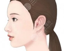 做下巴假体有没有后遗症？过来人实测：这些后遗症不是谣言，但也没那么可怕