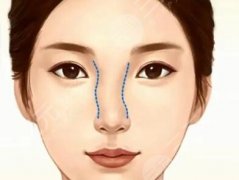 鼻头塑形和鼻头缩小区别有哪些？区别详情公布，看完再也不懵了
