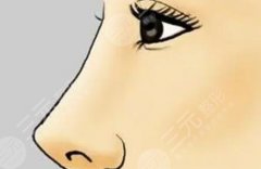 垫高鼻梁手术多少钱？2026全新价目表，普通人必看不踩坑