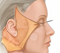 五层提升和大拉皮的区别有哪些？这两个项目的区别拆解开来了，速看