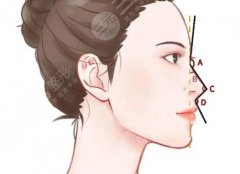 鼻中隔软骨隆鼻副作用是什么？先搞清楚这些副作用，医美党必看