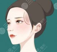 北京路会膨体填充太阳凹大概多少钱？医生资质-口碑-价格表公布！