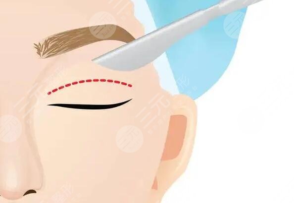 双眼皮修复