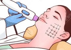 厦门三甲医院热玛吉，面诊必问问题+术后护理重点