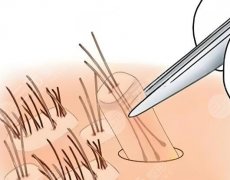 大连植发医院哪家医技术好？top榜单资料曝光，一起看看