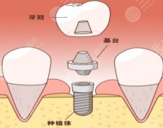 襄阳谷城时代口腔种植牙怎么样？多少钱？别急着下单先看这几个关键指标