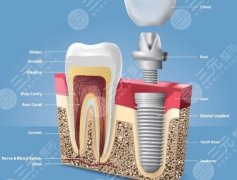 成都锦江贝臣口腔种植牙怎么样？多少钱？在锦江区做种植牙这个价位算贵吗？