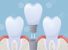 衢州蓝芽口腔诊所种植牙怎么样？多少钱？真实种牙口碑实测，收费区间一次摸清