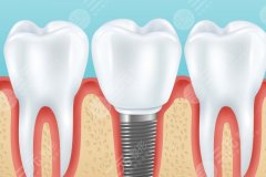 洛阳济仁口腔种植牙怎么样？多少钱？种植牙评价和收费标准帮你理清洛阳的朋友们，种牙这件事儿是不是也在你的