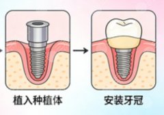 海南鼎格尔口腔种植牙怎么样？多少钱？真实种牙体验盘点，收费标准也在这