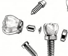 金华雅馨口腔种植牙怎么样？多少钱？真实口碑加收费参考，种牙前先做对比