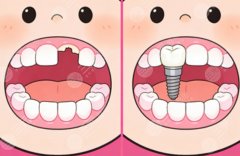 汕尾市牙喜士口腔种植牙怎么样？多少钱？真实种牙反馈盘点，收费档位顺手看