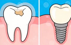 郑州爱度口腔种植牙怎么样？多少钱？种牙实力和收费水平，这篇一次说清