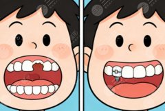 厦门现代口腔种植牙怎么样？多少钱？热门项目评价汇总，预算参考别错过