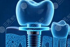 合肥同靓口腔种植牙怎么样？多少钱？种植牙到底靠不靠谱，费用也讲明白