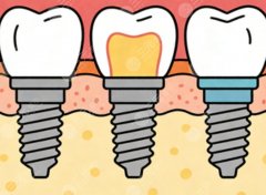 阜阳市瑞可口腔种植牙怎么样？多少钱？项目口碑和费用参考，这篇整理完毕