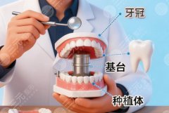 宜兴金铂利口腔种植牙怎么样？多少钱？真实口碑和价格区间分享