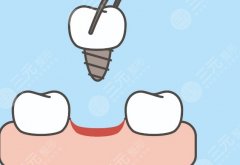 汕头奥诗卡口腔种植牙怎么样？多少钱？种植体验和价位参考都在这