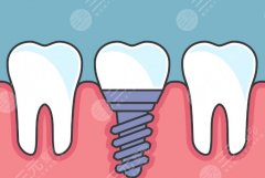 沈阳欢乐仁爱口腔医院种植牙怎么样？多少钱？医院口碑和种牙费用一文汇总