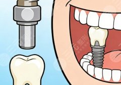 普宁金铂利口腔种植牙怎么样？多少钱？种植牙评价和收费情况都在这