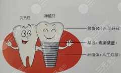 内蒙古呼和浩特天牙口腔种植牙怎么样？多少钱？口碑表现和费用区间一并了解
