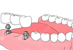 乐山医大口腔种植牙怎么样？多少钱？技术优势和价格参考整理好了
