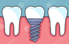 昭通牙管家种植牙怎么样？多少钱？医院亮点与价格信息整理汇总