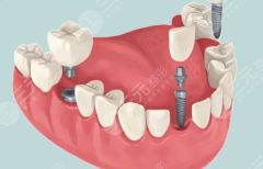 襄阳海峡明朗口腔种植牙怎么样？多少钱？种牙水平和收费细节公布